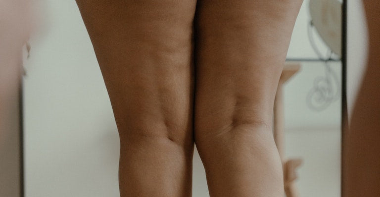 Inner Thigh Chafing: Causes and Ways to Treat It – Thigh Society