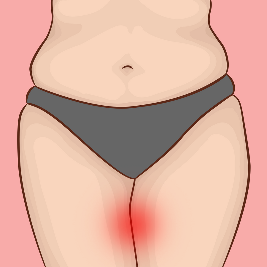 Care for Chafed Inner Thighs